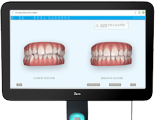 マウスピース矯正（インビザライン）