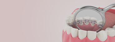 裏側矯正（舌側矯正）