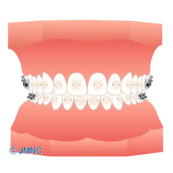 表側でも目立ちにくいワイヤー矯正