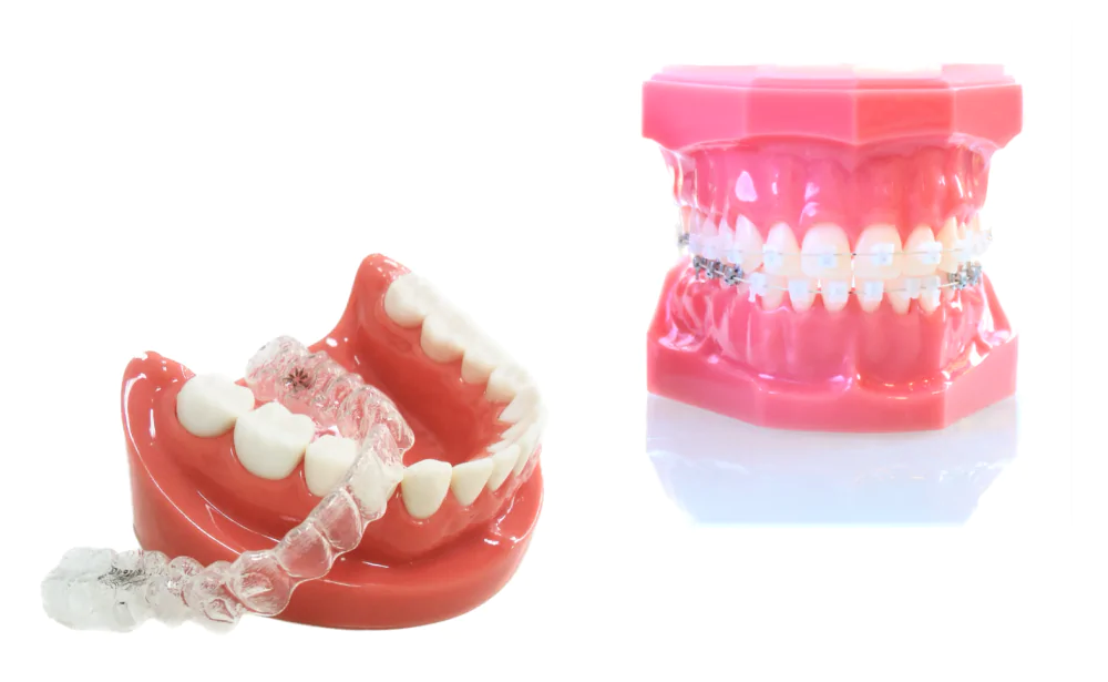 ワイヤー矯正とマウスピース矯正を併用した矯正治療